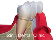 歯周外科処置・再生療法