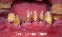 歯周外科処置・再生療法