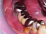 ブリッジや義歯による治療の弊害