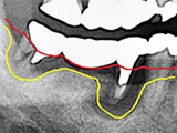 ブリッジや義歯による治療の弊害