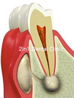 歯根の先端に細菌の塊（根尖病巣）が炎症