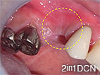 ①第１小臼歯と第２小臼歯の２本の歯が欠損しています。歯茎が陥没しているのが分かります（黄マーク部）。