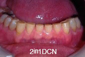 歯ぎしりの症例写真1
