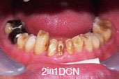 歯ぎしりの症例写真2