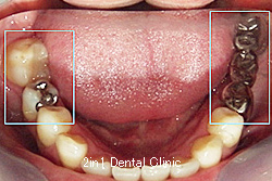 症例11　部分的歯列矯正治療　＋　ハイブリッドセラミッククラウン　ブリッジ（Gradia Forte）