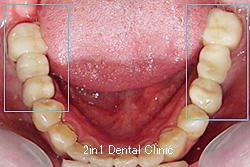 症例11　部分的歯列矯正治療　＋　ハイブリッドセラミッククラウン　ブリッジ（Gradia Forte）