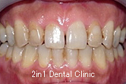 症例1　部分矯正治療＋歯肉形成＋アルミナ　オールセラミッククラウン（Procera）