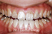 矯正歯科の症例１０（下顎前突の症例）