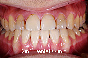 矯正歯科の症例１０（下顎前突の症例）