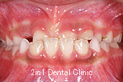矯正歯科の症例１１（下顎前突の症例）