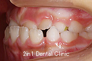 矯正歯科の症例１１（下顎前突の症例）