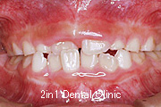 矯正歯科の症例１２（上顎前歯の反対咬合の症例）