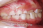 矯正歯科の症例１２（上顎前歯の反対咬合の症例）