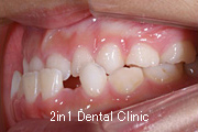矯正歯科の症例１３（上顎前歯の反対咬合の症例）