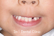 矯正歯科の症例１３（上顎前歯の反対咬合の症例）