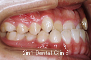 矯正歯科の症例１４（上顎前歯の反対咬合の症例）