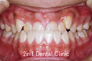 矯正歯科の症例１４（上顎前歯の反対咬合の症例）