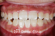 矯正歯科の症例１５（上顎前歯の反対咬合の症例）