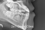 矯正歯科の症例１５（上顎前歯の反対咬合の症例）