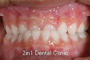 矯正歯科の症例１６（上顎前歯の反対咬合の症例）