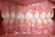矯正歯科の症例１６（上顎前歯の反対咬合の症例）