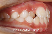 矯正歯科の症例１７（上顎前歯の反対咬合の症例）