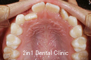 矯正歯科の症例１７（上顎前歯の反対咬合の症例）