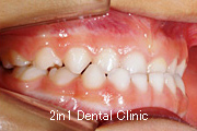 矯正歯科の症例１８（上顎前歯の反対咬合の症例）