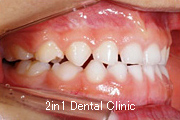 矯正歯科の症例１８（上顎前歯の反対咬合の症例）