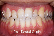 矯正歯科の症例１９（上顎前歯の反対咬合の症例）