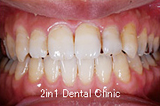 矯正歯科の症例１９（上顎前歯の反対咬合の症例）