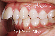 矯正歯科の症例１（上顎前突の症例）