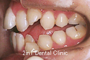 矯正歯科の症例２０（開咬の症例）