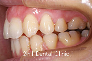 矯正歯科の症例２０（開咬の症例）
