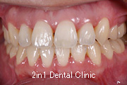 矯正歯科の症例２１（開咬の症例）