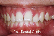 矯正歯科の症例２２（叢生の症例）