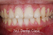 矯正歯科の症例２２（叢生の症例）