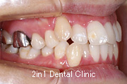 矯正歯科の症例２３（叢生の症例）