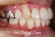 矯正歯科の症例２３（叢生の症例）