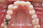 矯正歯科の症例２４（叢生の症例）