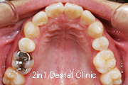 矯正歯科の症例２４（叢生の症例）