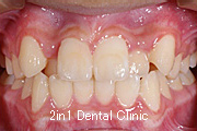 矯正歯科の症例２５（叢生の症例）