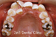 矯正歯科の症例２６（叢生の症例）
