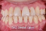 矯正歯科の症例２６（叢生の症例）