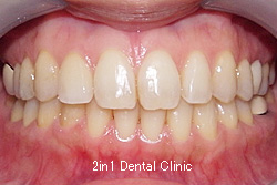 矯正歯科の症例２７（正中離開の症例）