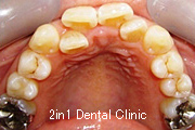 矯正歯科の症例２８（叢生の症例）