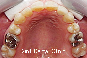 矯正歯科の症例２８（叢生の症例）