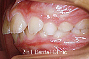 矯正歯科の症例２（上顎前突の症例）