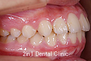 矯正歯科の症例２（上顎前突の症例）