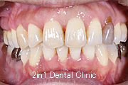 矯正歯科の症例３（上顎前突の症例）